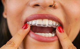 Woman placing Invisalign aligner on her top teeth