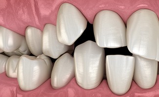 Illustration of spaced-out teeth