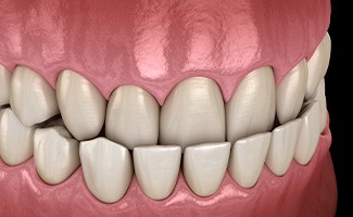 Illustration of an underbite