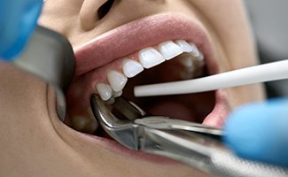 A dentist grabbing onto a dental patient’s infected tooth with tools