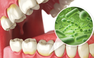 Illustration showing bacteria along the gumline