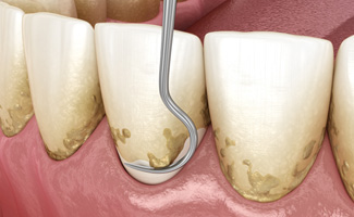 Illustration of dental scaler cleaning the teeth