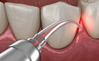 Illustration of dental laser being used to treat gum tissue