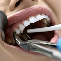 Patient in Reno getting an extraction instead of root canals