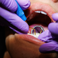 Hygienist performing scaling and root planing in Reno