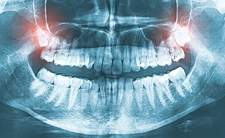 Wisdom teeth are extra molars in Reno, NV